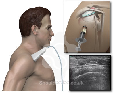 Glenohumeral joint steroid injection technique