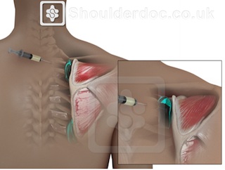 Snapping Scapula Shoulderdoc