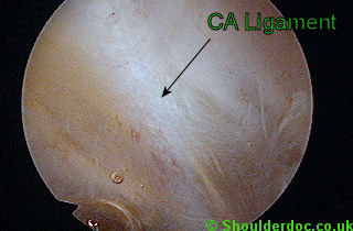 View through scope inside bursa before removal of the CA Ligament