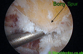 Acromial bone spur seen at arthroscopy
