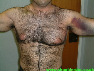 Left pec major rupture. Note bruising, loss of normal axillary shape and asymmetrical chest