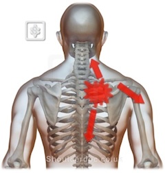 Slipping Rib Syndrome - Physiopedia