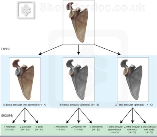 Scapula Fracture Types