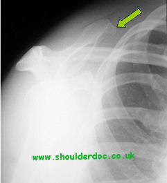 Snapping Scapula  Advanced Orthopaedics & Sports Medicine