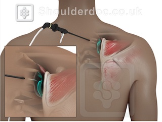 Snapping Scapula | ShoulderDoc