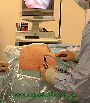 Thoracoscapular arthroscopy